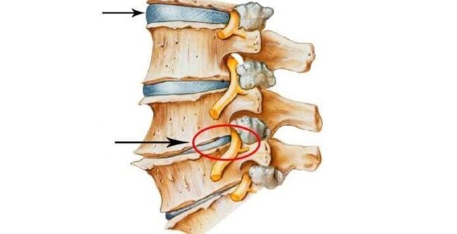 disco espinal san e danado con osteocondrose cervical