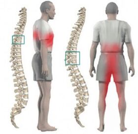 danos na columna vertebral e dor na osteocondrose torácica
