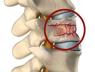 As causas da dor nas costas poden ser enfermidades da columna vertebral e dos discos intervertebrais. 