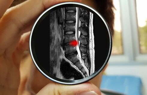 A consecuencia de ignorar a dor lumbar pode ser unha hernia discal. 