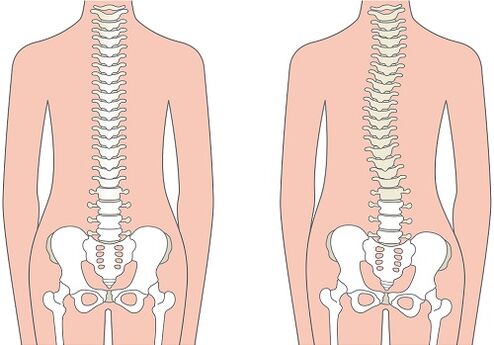 Dor lumbar debido a deformidades da columna vertebral como a escoliose
