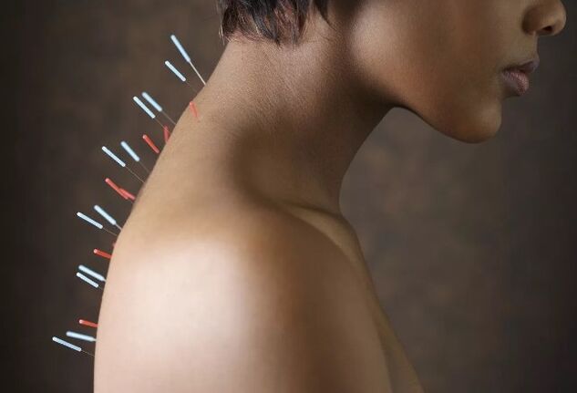 Acupuntura