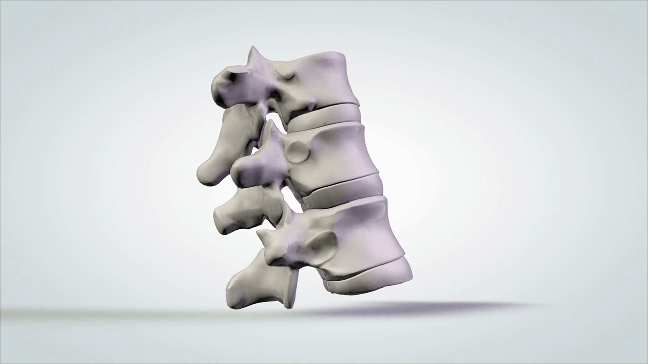 danos na columna vertebral debido á osteocondrose cervical