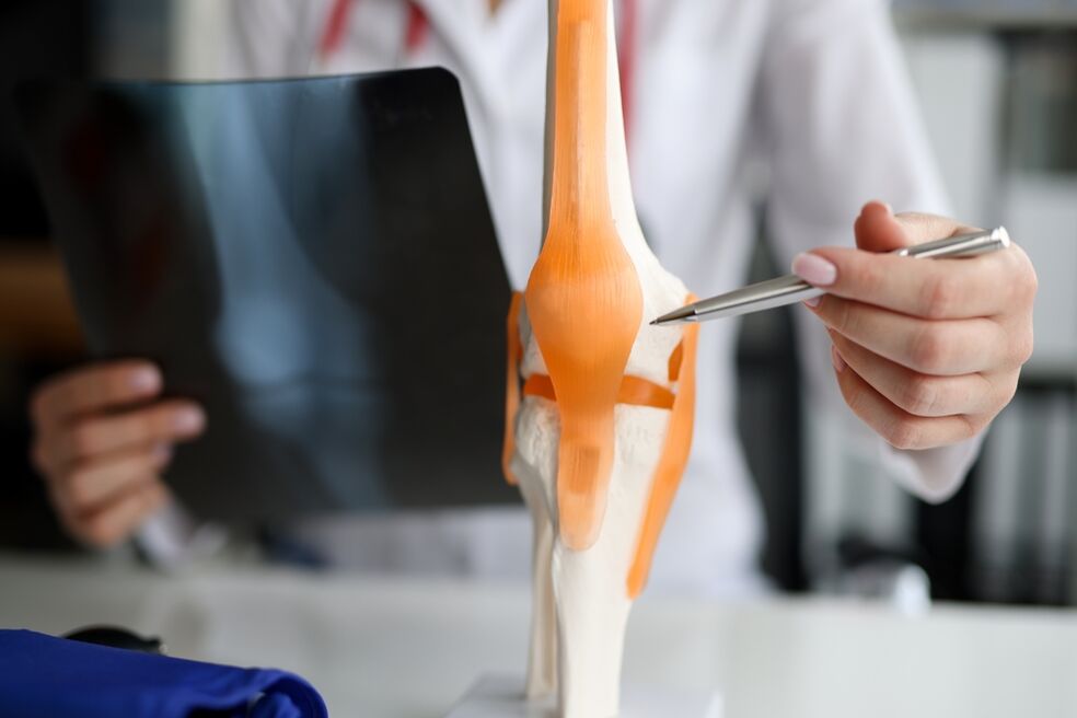 Demostración dunha articulación na que os cambios dexenerativos conducen ao desenvolvemento de artrose