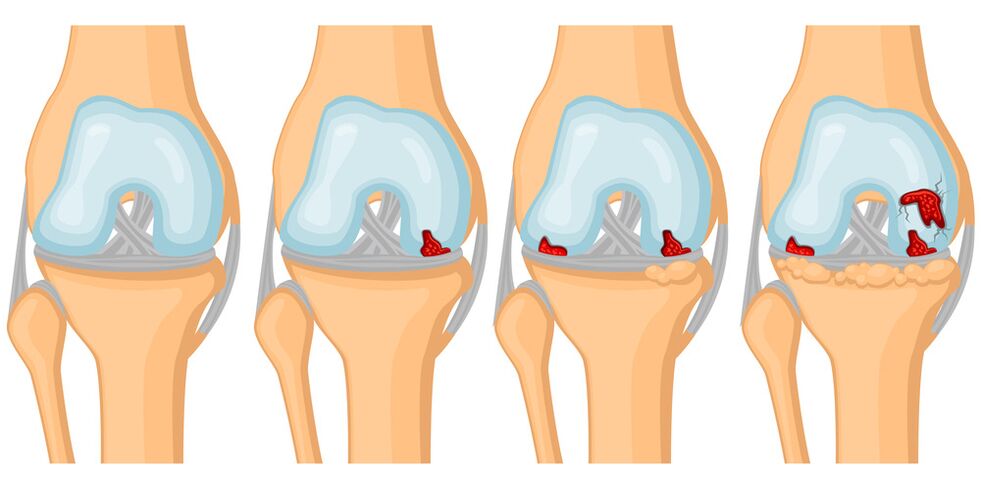 Grao de desenvolvemento da artrose articular