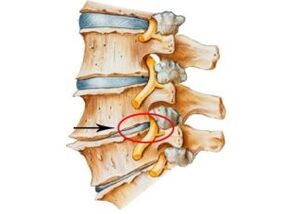 signos e síntomas da osteocondrose